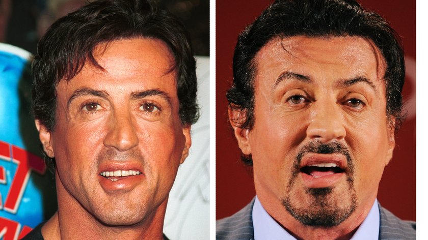 Sylvester Stallone vorher nachher