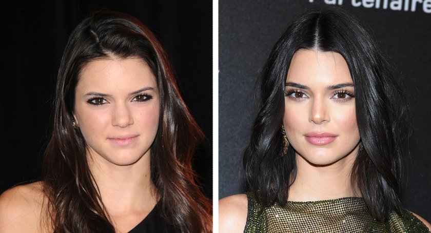 Kendall Jenner vorher nachher